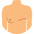 Gynaecomastia