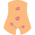 Hernia