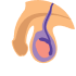 Hydrocele