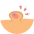 Sebaceous Cyst