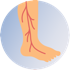 Varicose Veins