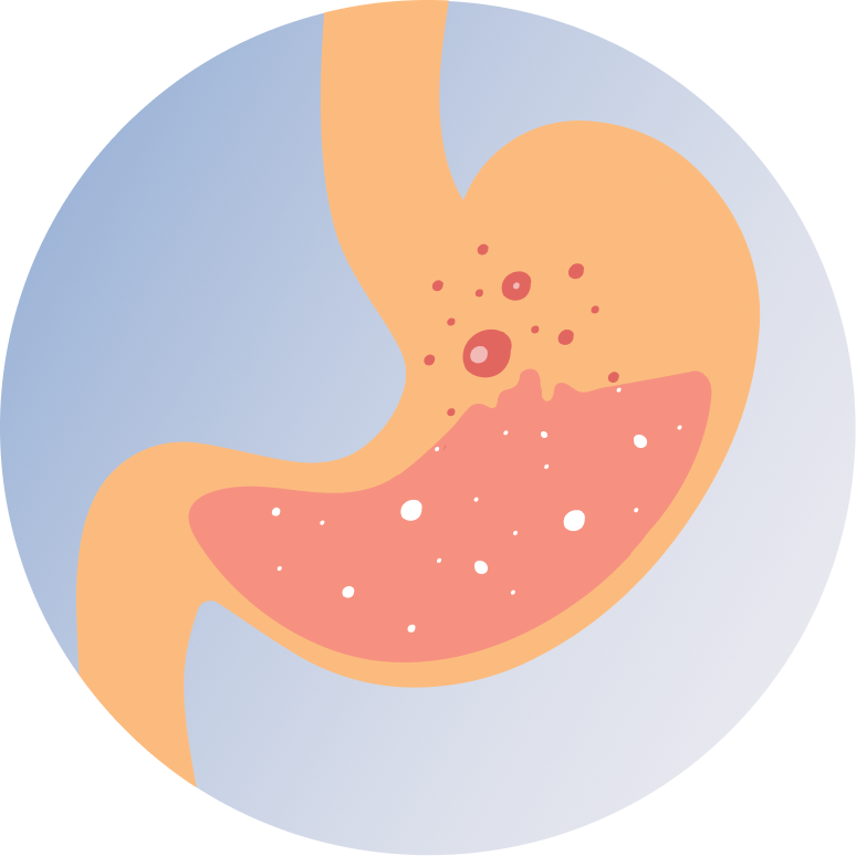 GERD Surgery