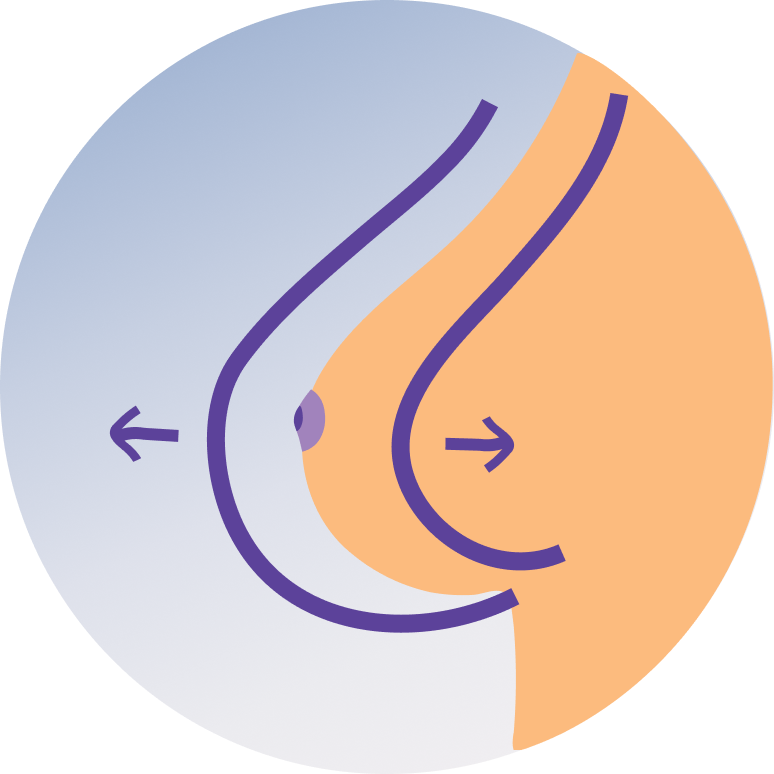 Breast Implant