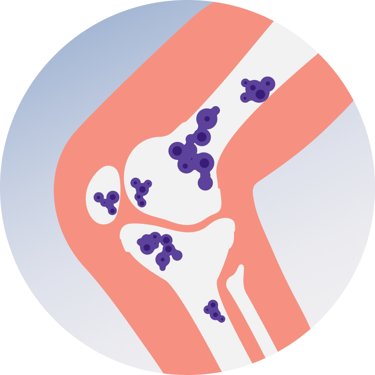 Ewing's Sarcoma Treatment