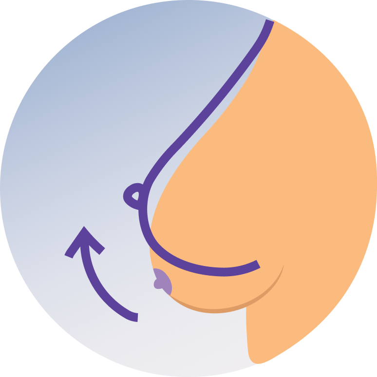 Breast lift