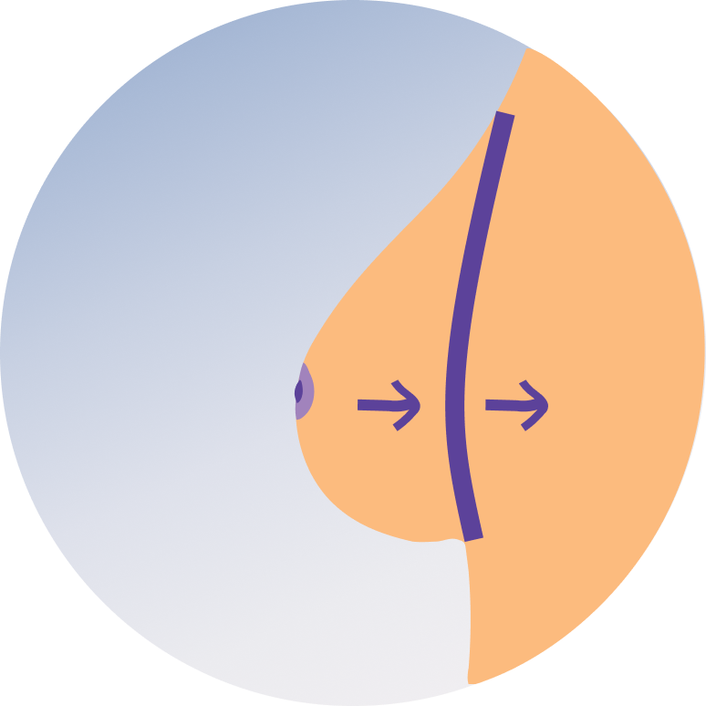 Reduction Mammoplasty (Breast Reduction Surgery)