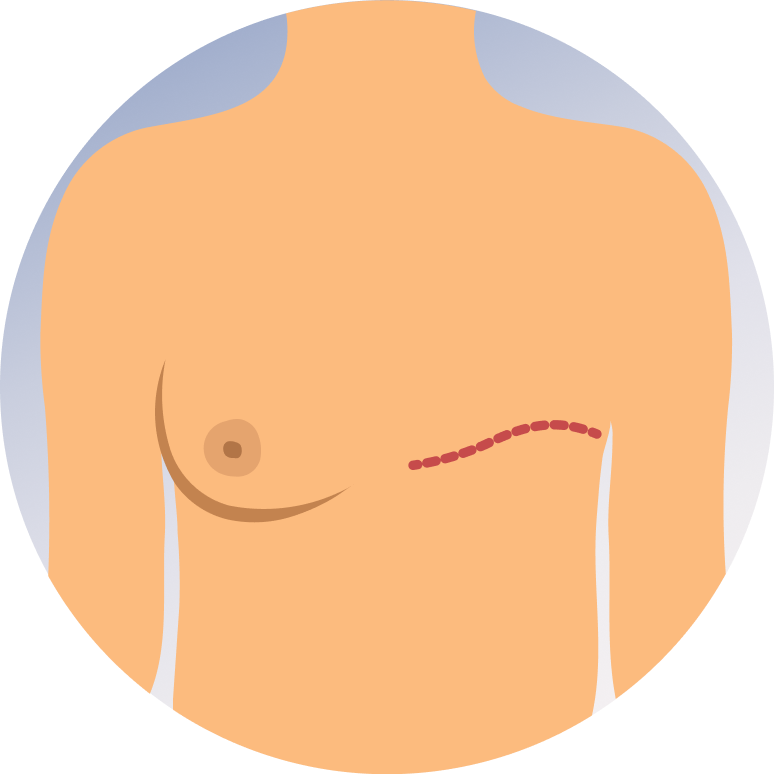 Breast reconstruction