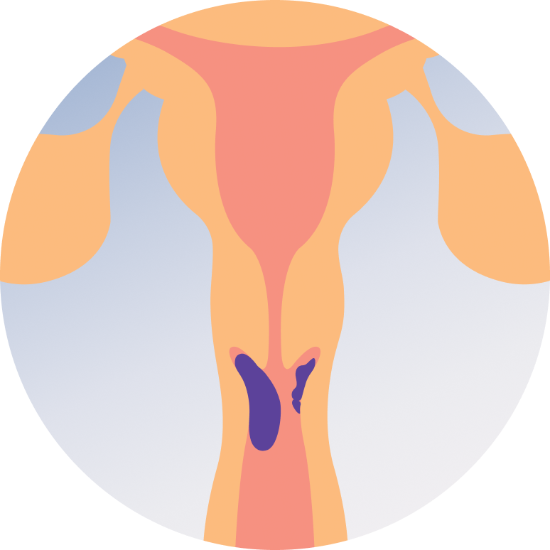 Treatment of Cervical Cancer