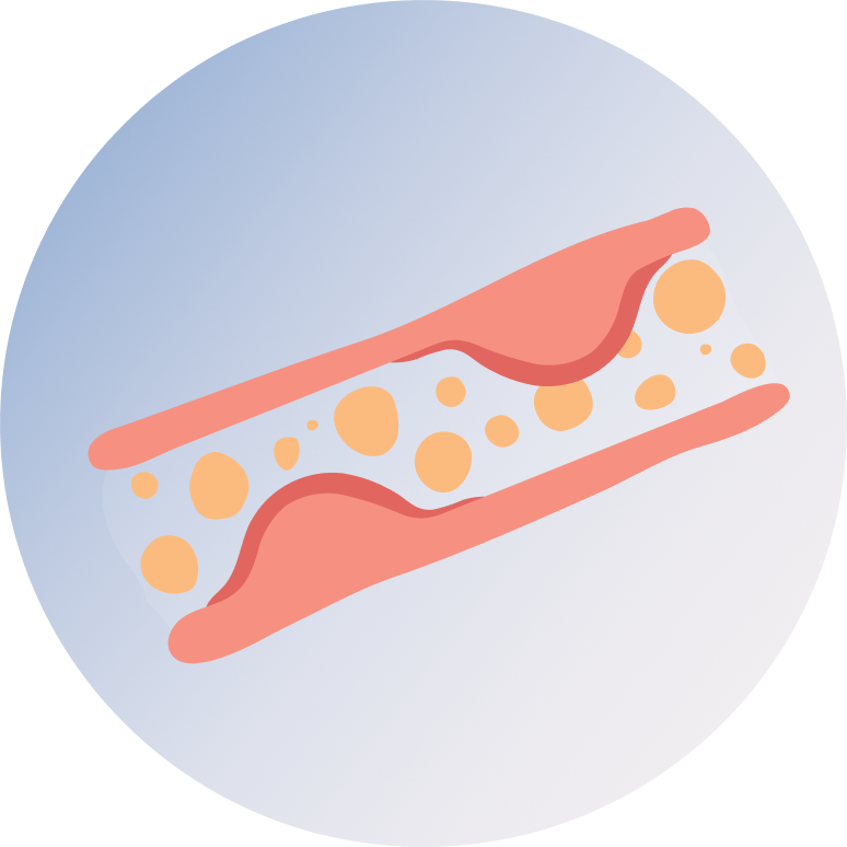Hyperlipidemia