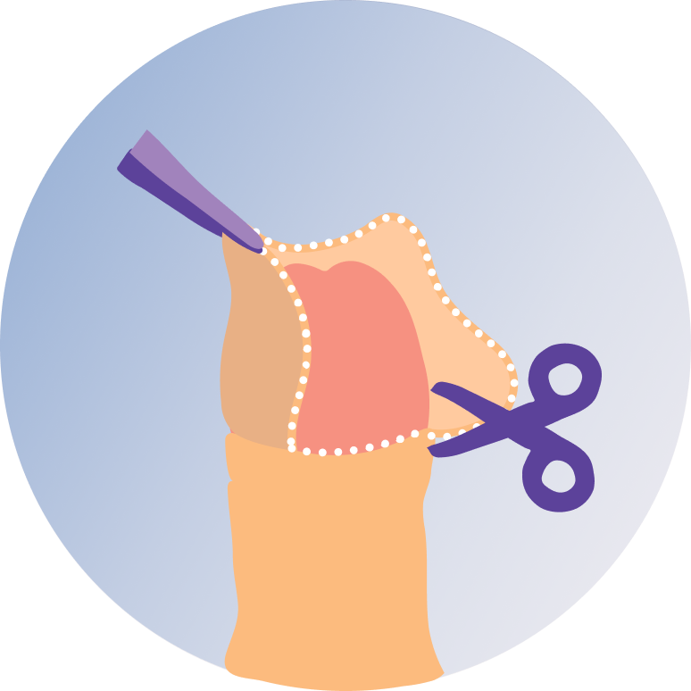 Circumcision