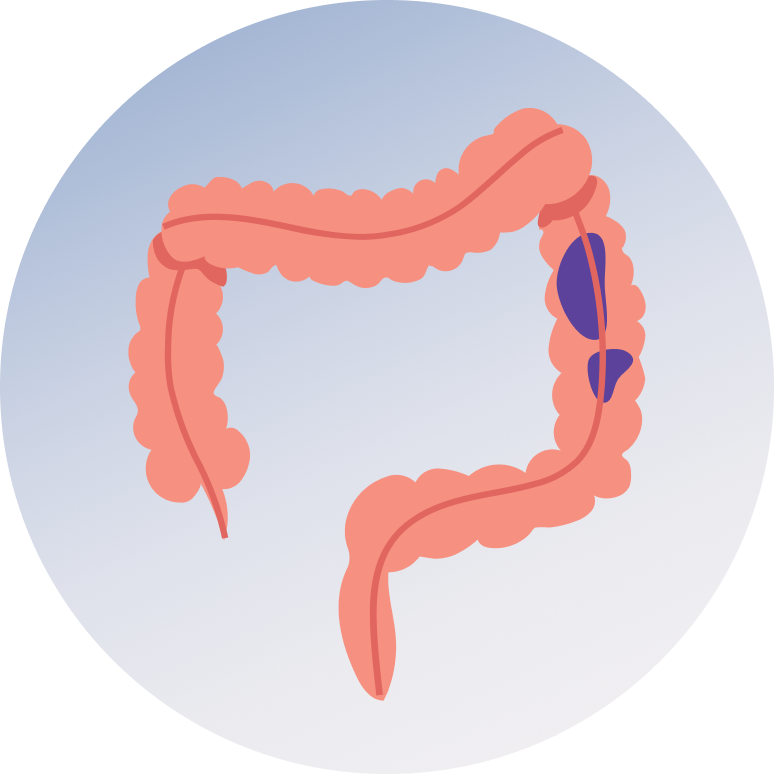 Fecal Occult Blood Test for Colorectal Cancer
