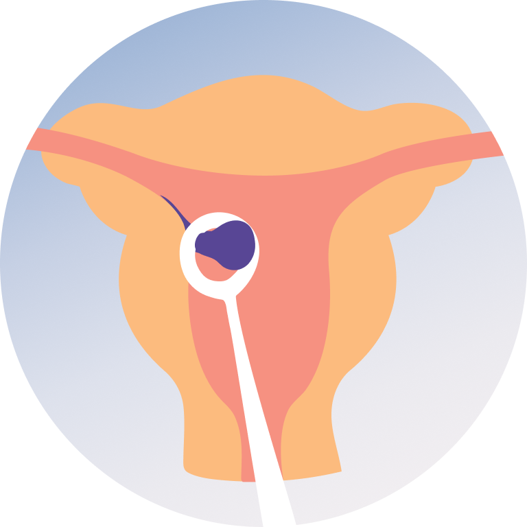 D&C (Dilation and Curettage)