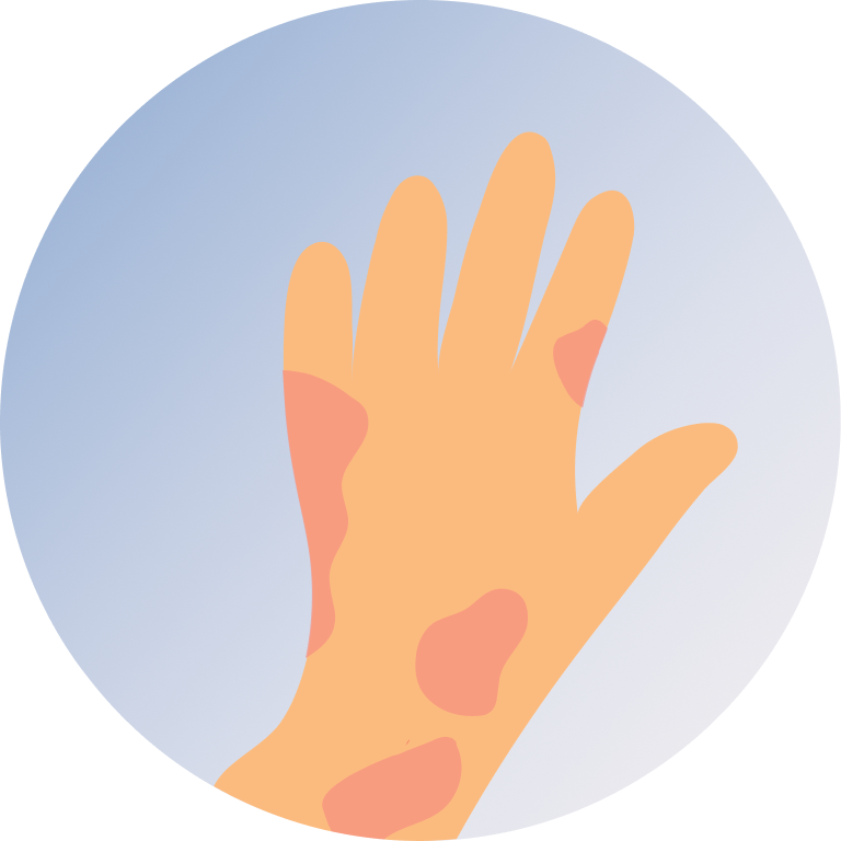 ECZEMA