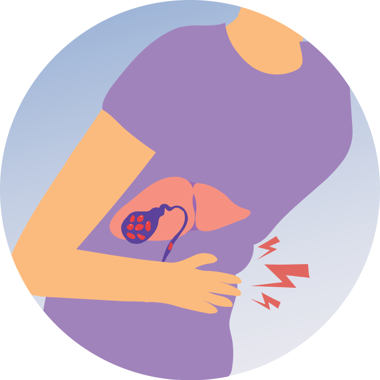 Gallstones