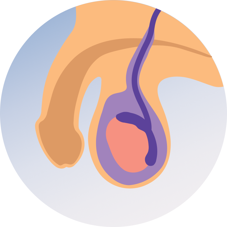 Hydrocele