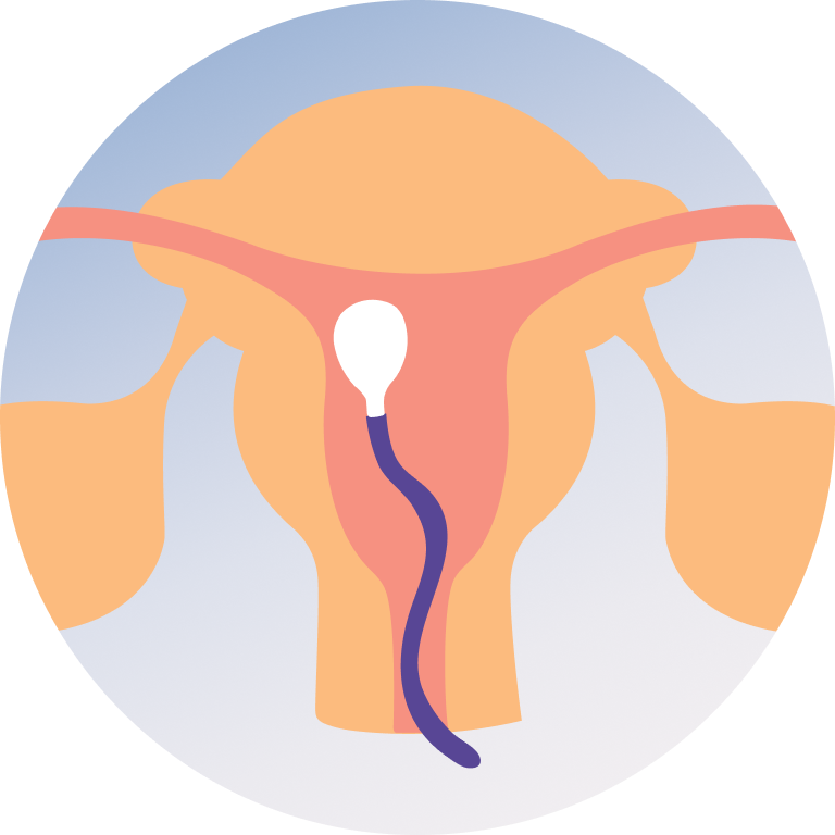 Diagnostic Hysteroscopy
