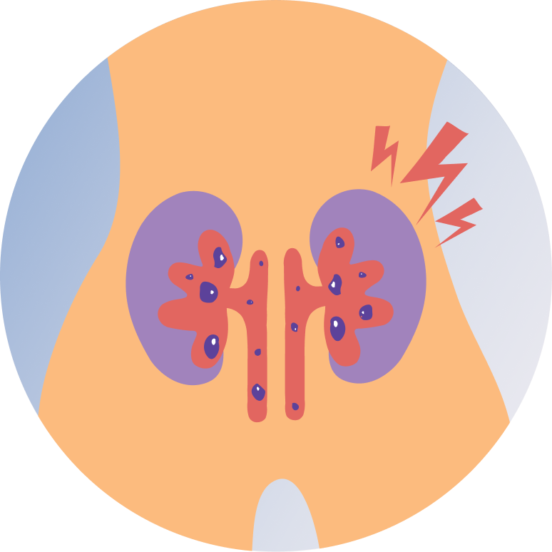 Extracorporeal Shock Wave Lithotripsy (ESWL)