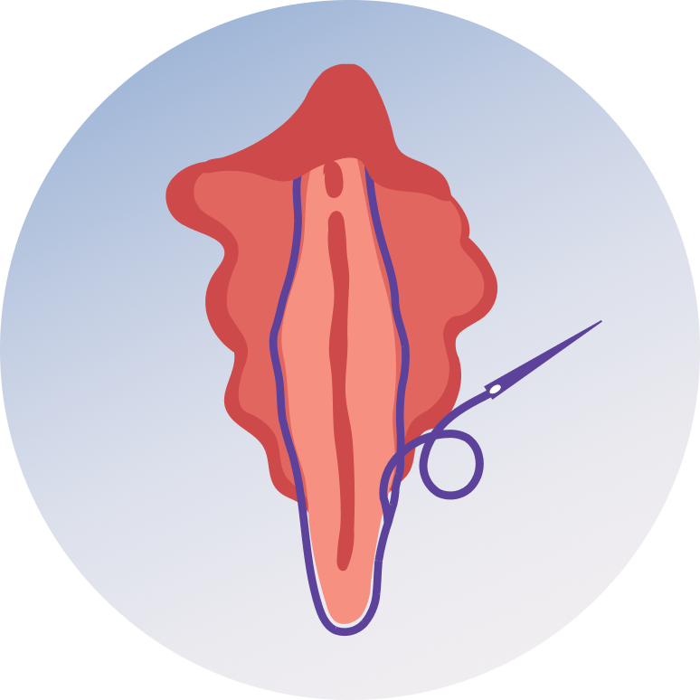 Labiaplasty