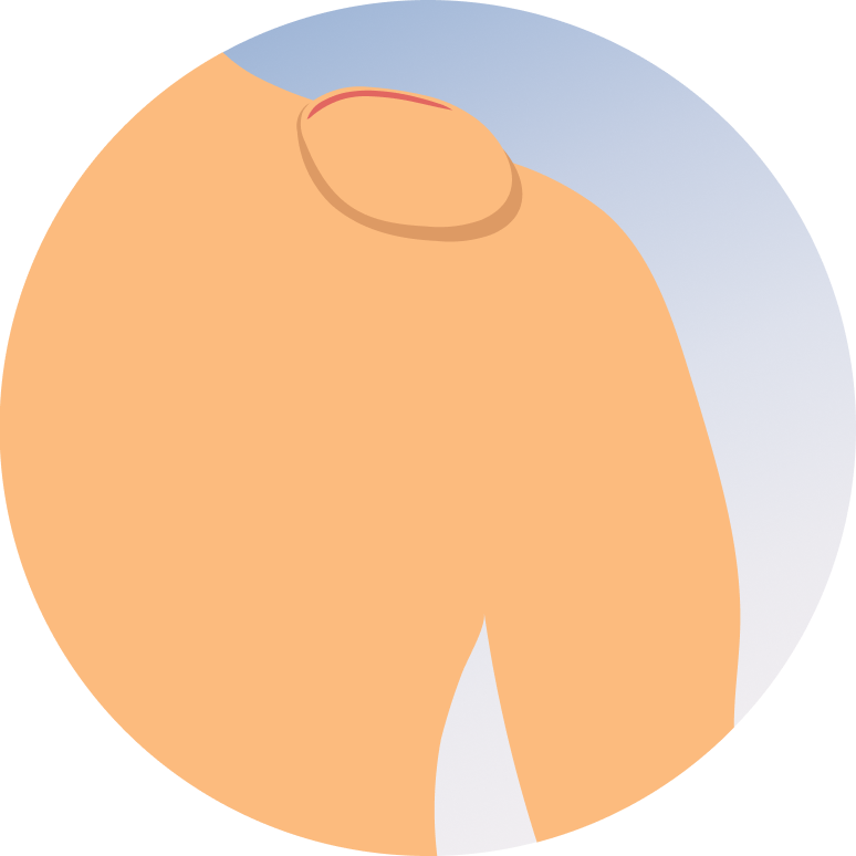 Lipoma