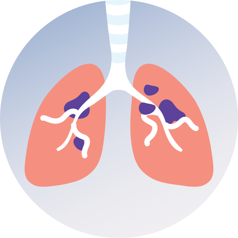 Lung Cancer Treatment