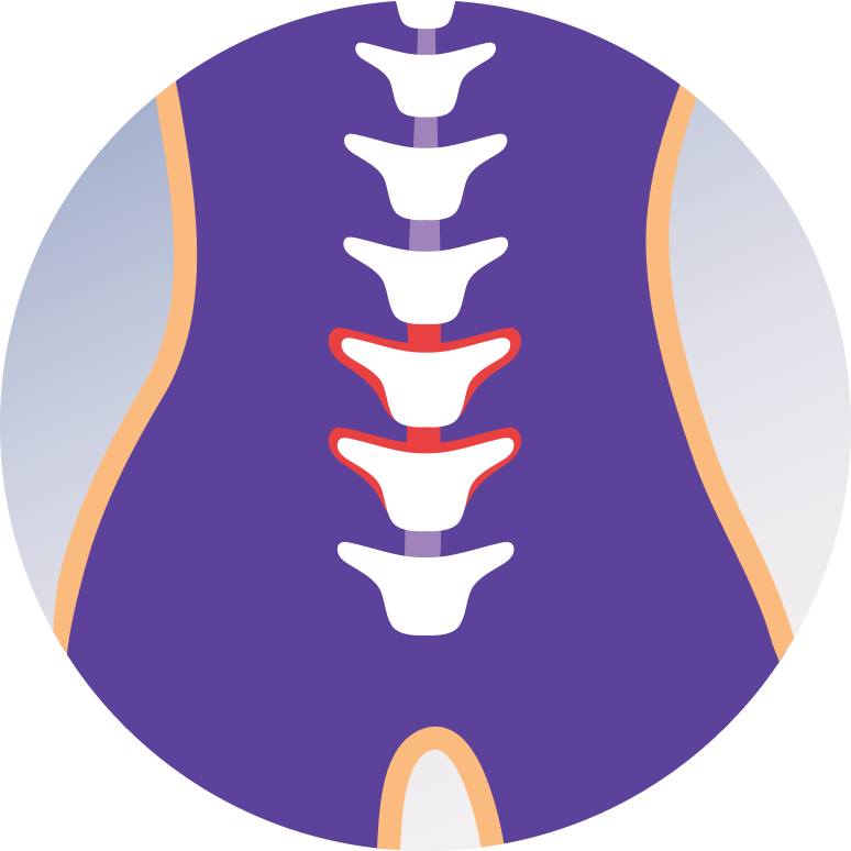 Disc Prolapse