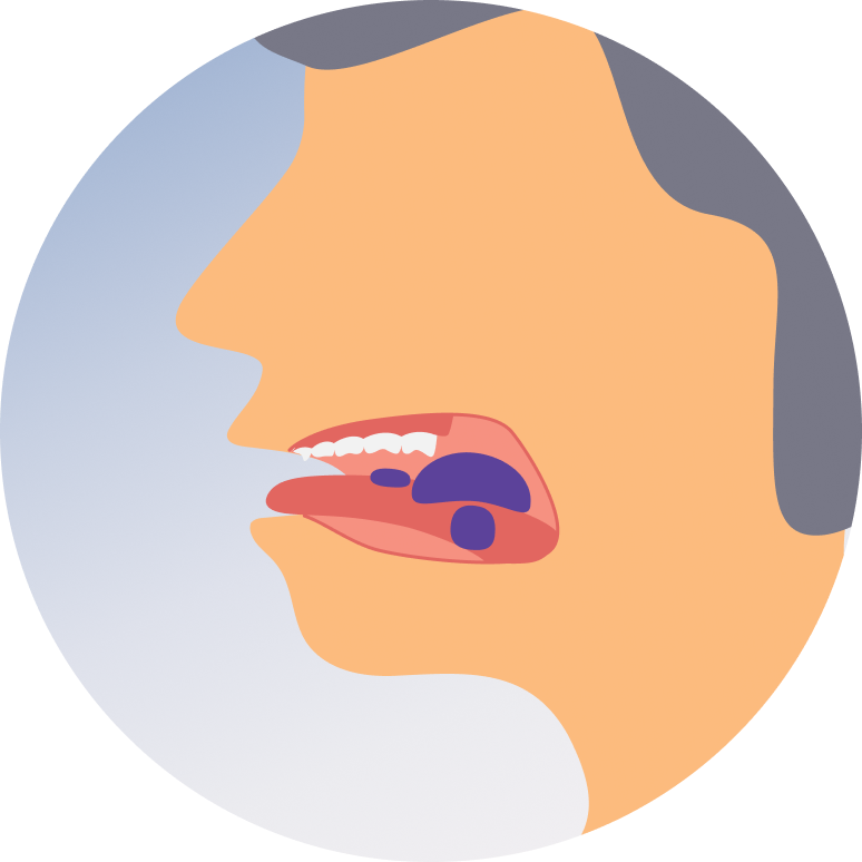Mouth Cancer