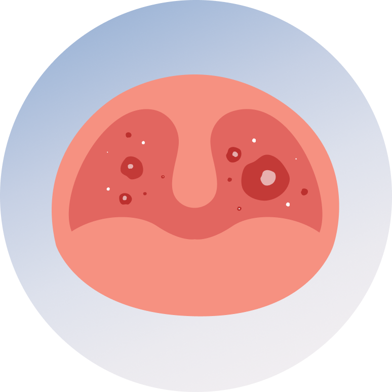 Mouth Ulcers