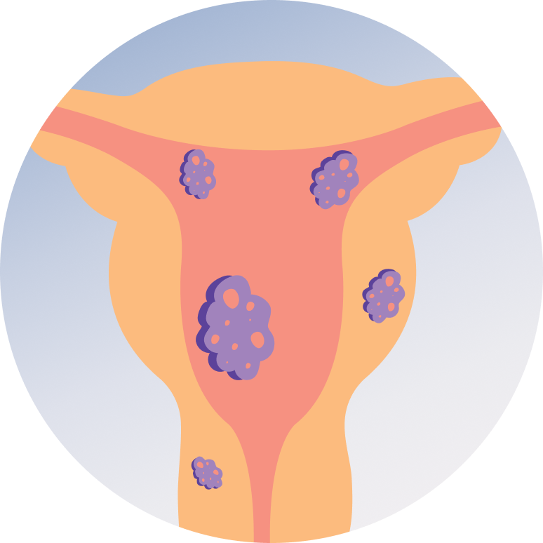 Uterine Fibroid Embolization (UFE)