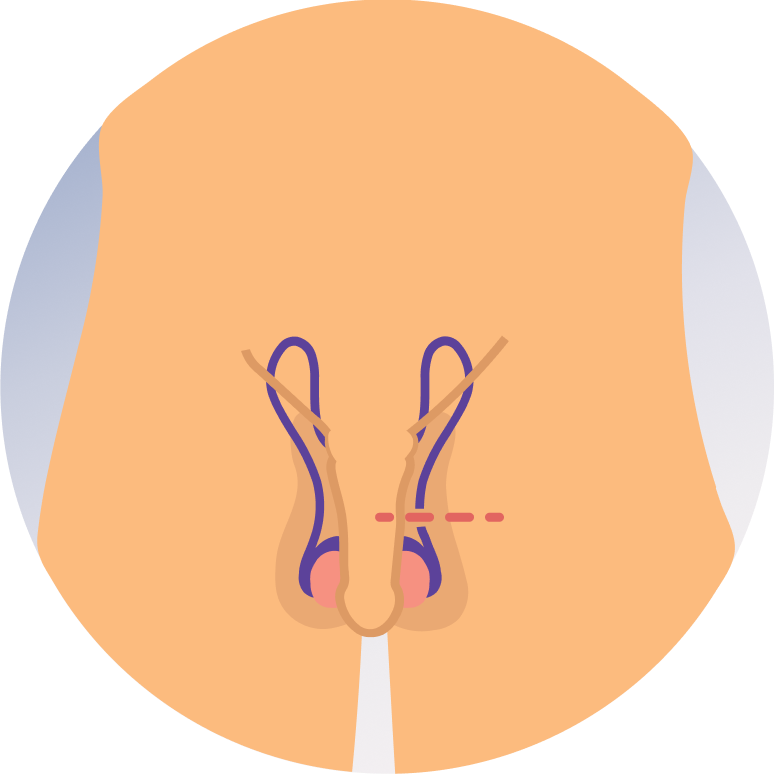Testicular Surgery