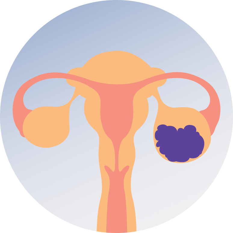 Ovarian Cancer Screening