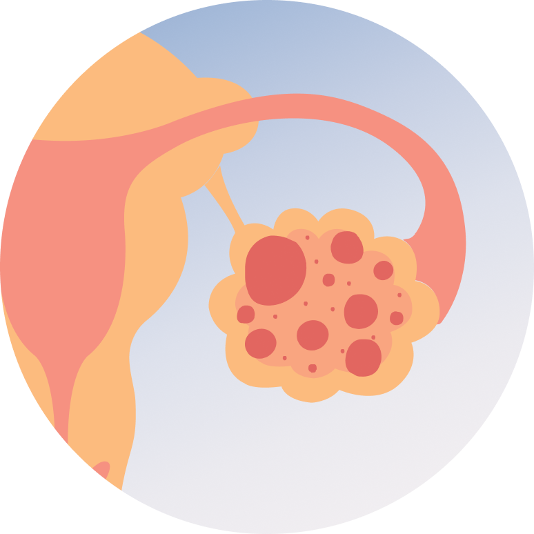 Open Ovarian Cyst Surgery
