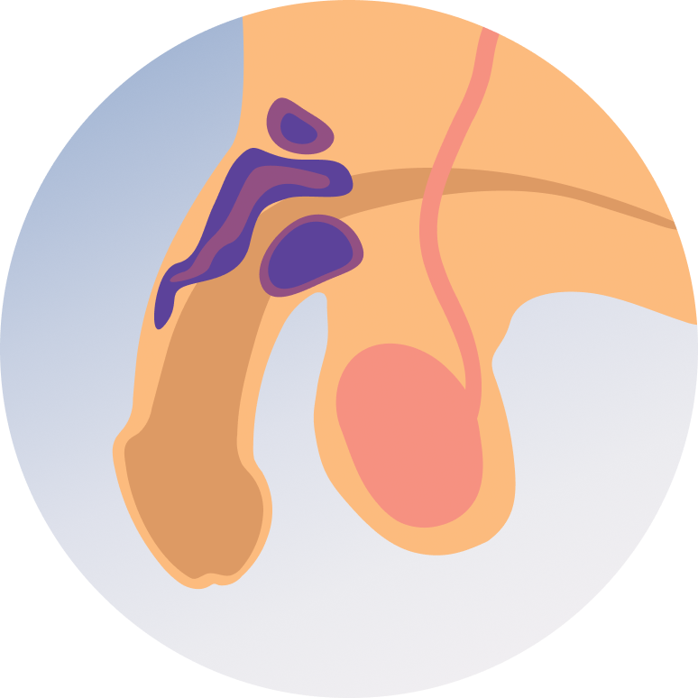 Penile Cancer