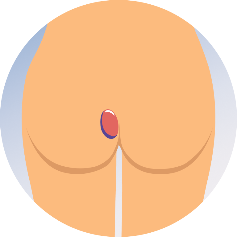 Perianal Abscess Drainage