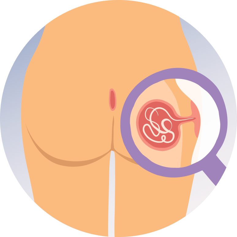 Pilonidal Sinus Flap Repair