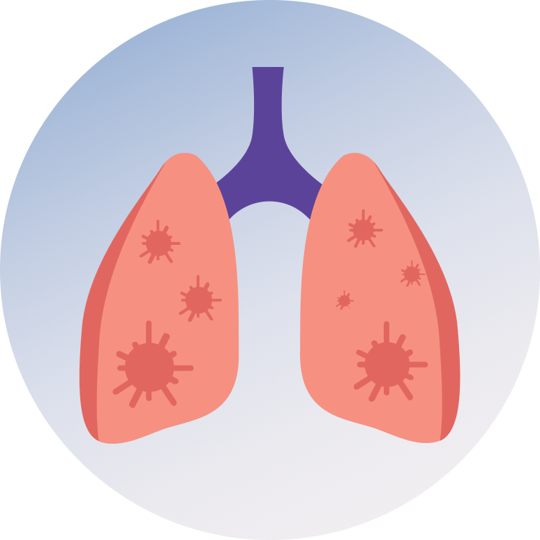  Pneumonia