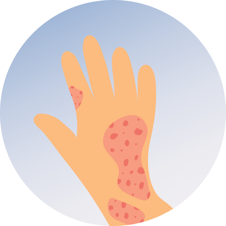 Psoriasis Treatment