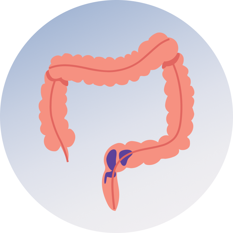 Rectal Cancer