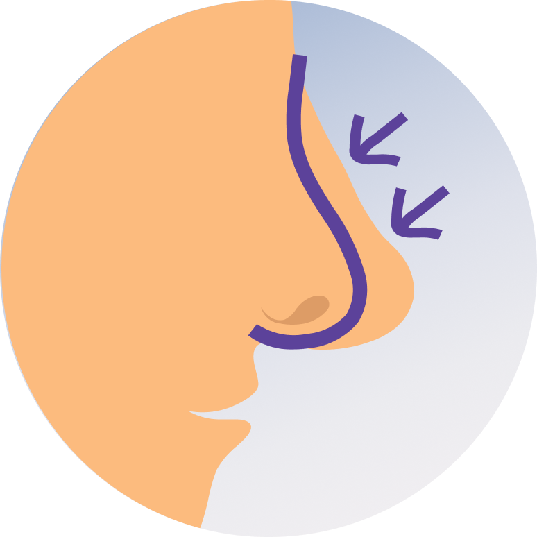 Rhinoplasty