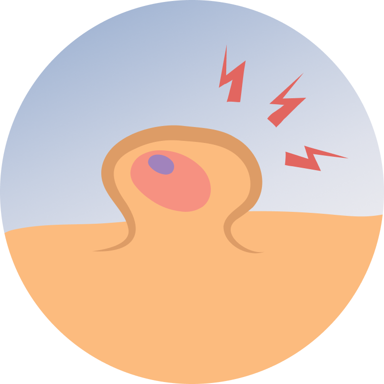 Sebaceous Cysts