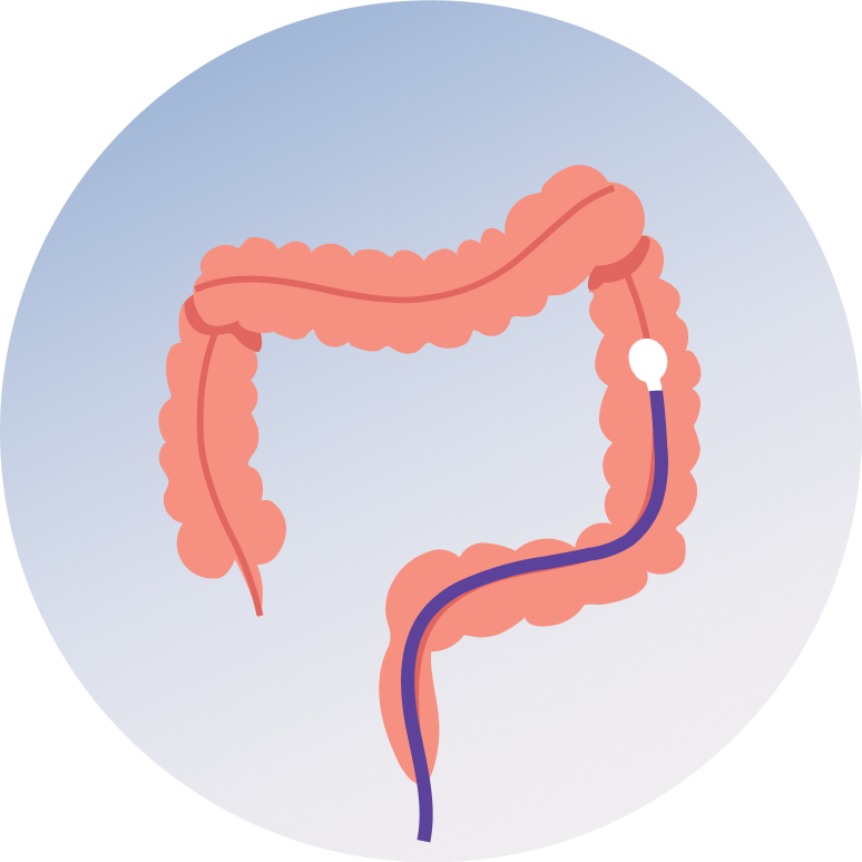 Sigmoidoscopy