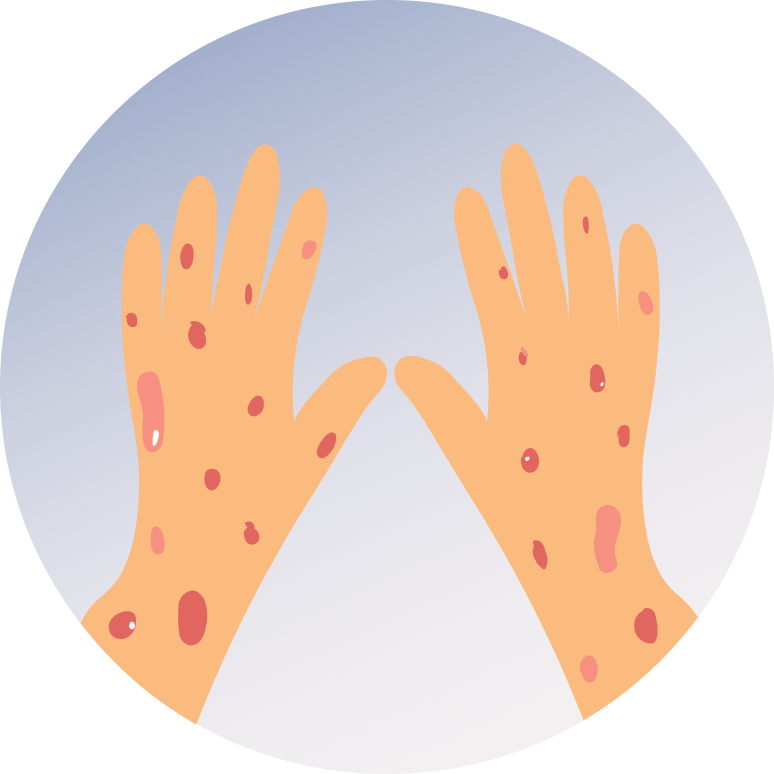 Skin Allergy
