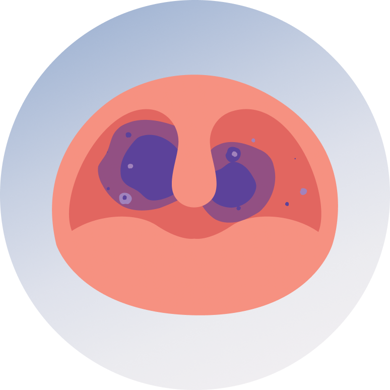 Throat Cancer