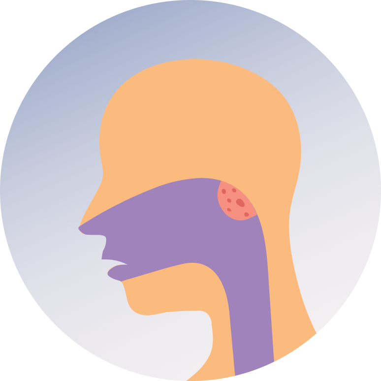 laryngectomy