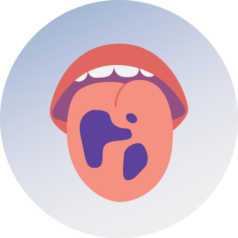 Tongue Cancer