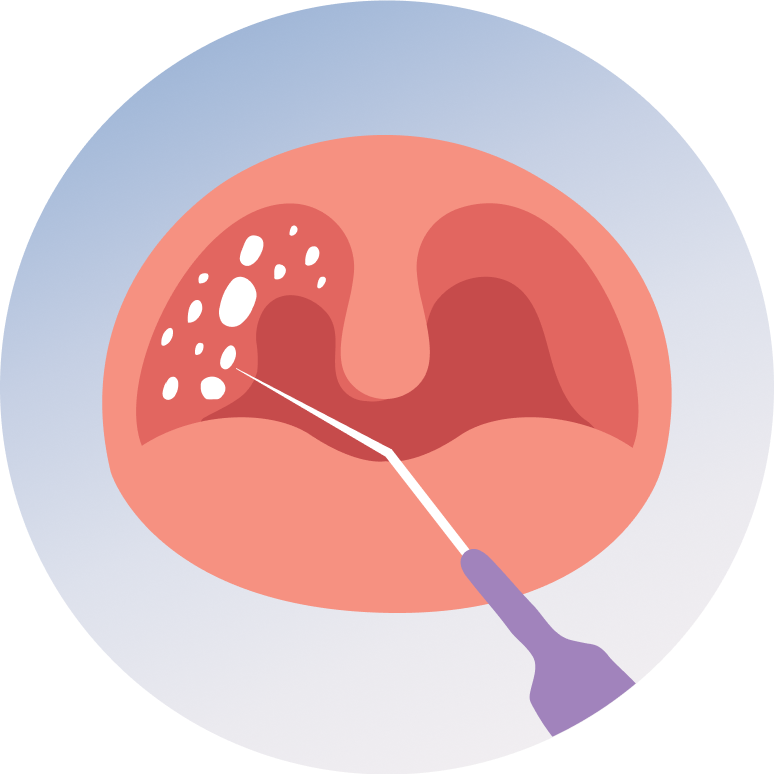 Tonsillectomy