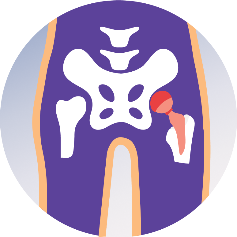 Hip Replacement