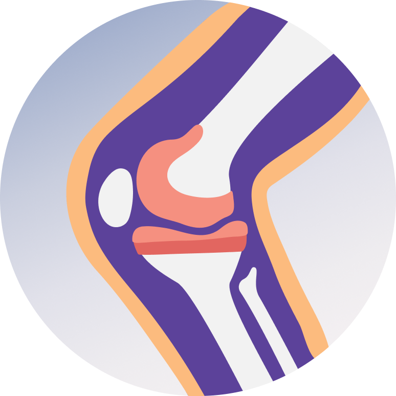 Knee Replacement