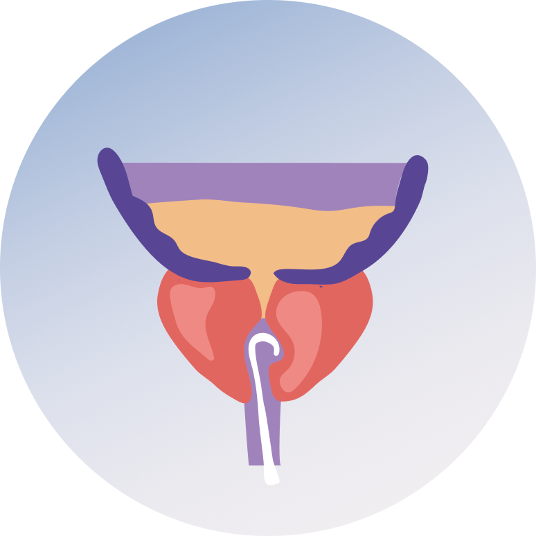 Transurethral Resection of The Prostate (TURP)