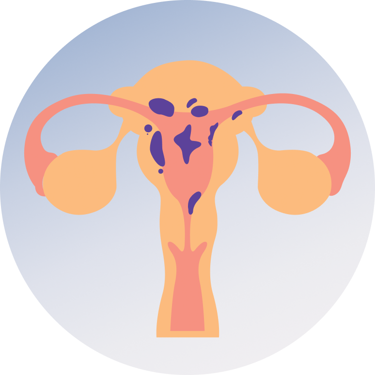 Uterine Cancer