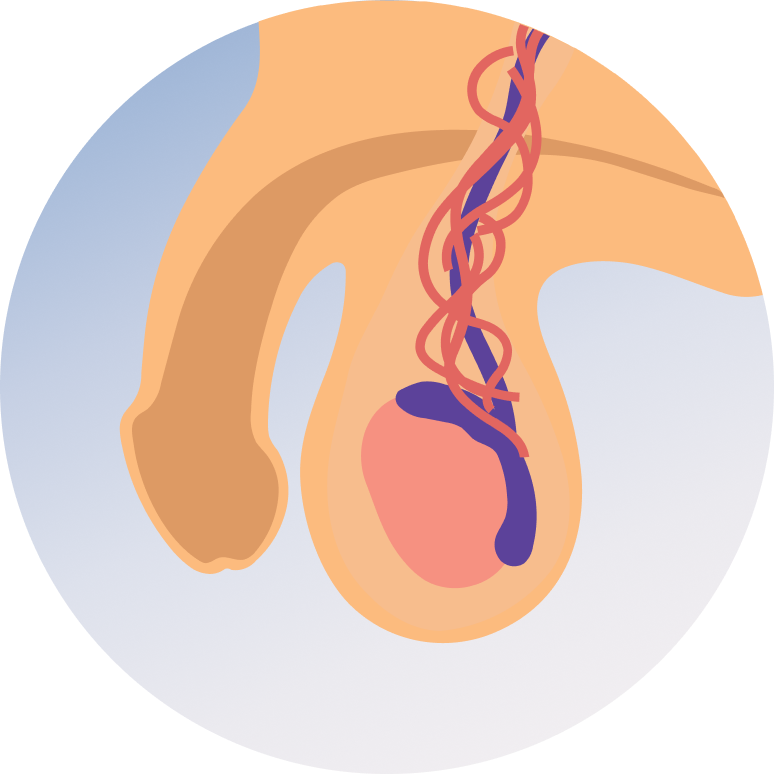 Varicocele Surgery